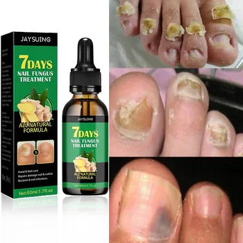 Лечение на гъбички на ноктите Серумна грижа Грижа за ръцете и краката Отстраняване Ремонт гел Антиинфекциозна онихомикоза - Изображение 1  